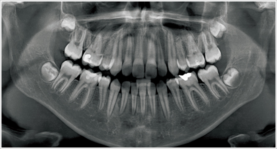 根管治疗检查之牙科x光与显微镜_牙齿