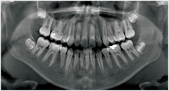 颗牙齿的单齿x光片,或是整个口腔拍摄的环口 x 光片,以及其它〈咬翼片