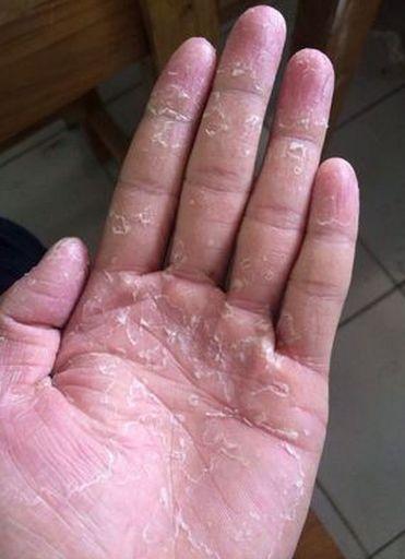 出现汗疱疹的人一开始在手部就会出现一些水泡,同时伴随着瘙痒.