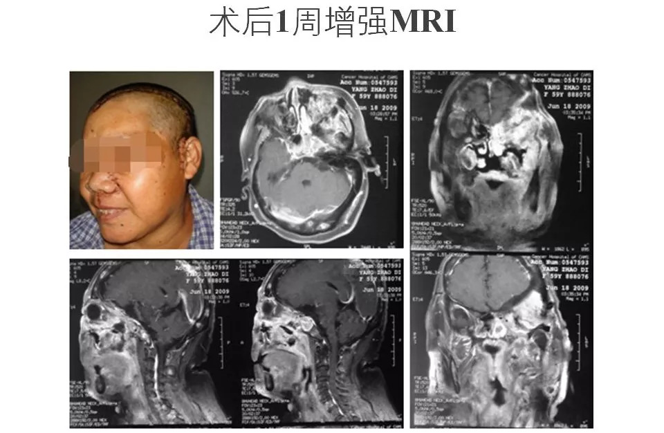 [cns2018] 医科院肿瘤医院万经海: 颅底沟通性脑膜瘤的外科治疗