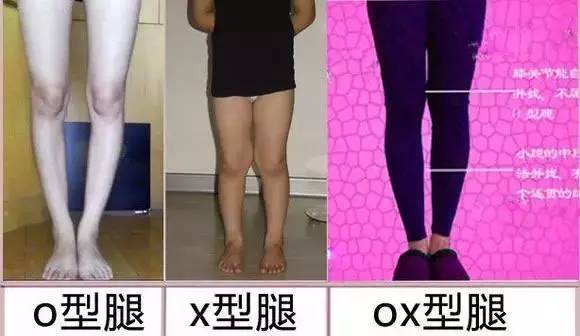 腰长加o型腿怎么搭_o型腿图片(3)