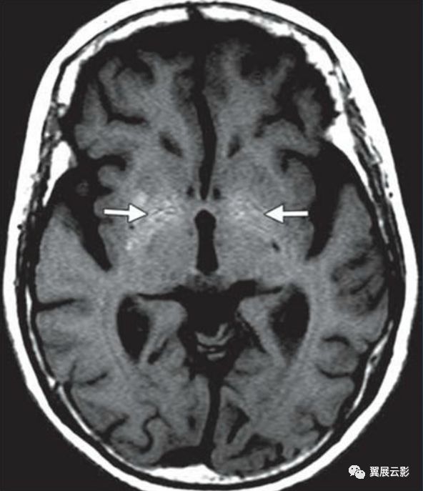基底节区及丘脑对称性病变mri诊断