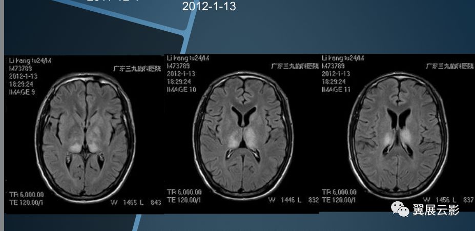 基底节区及丘脑对称性病变mri诊断