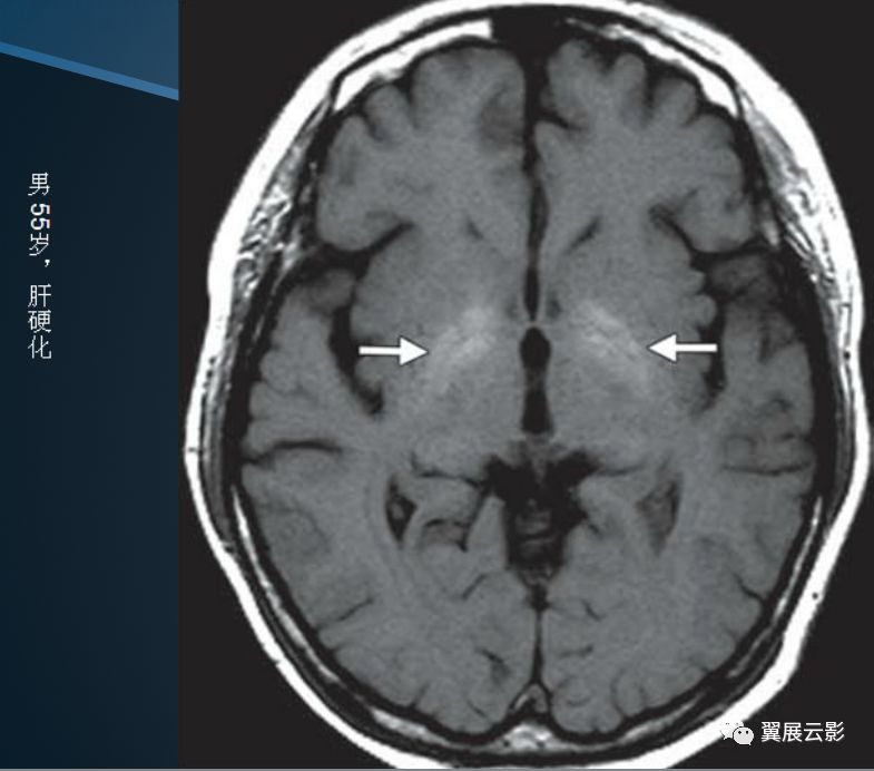 基底节区及丘脑对称性病变mri诊断