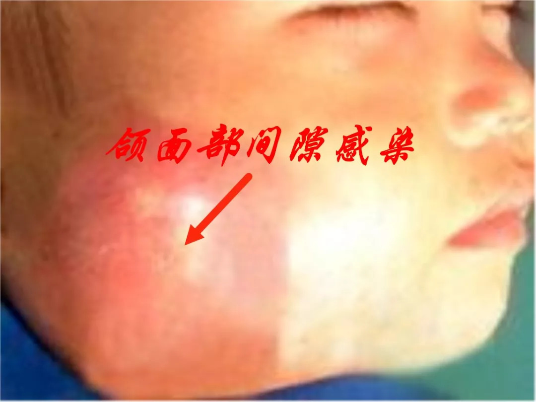 颌面部(口腔)软组织有许多潜在间隙(如颊间隙,咬肌间隙,颌下间隙等)