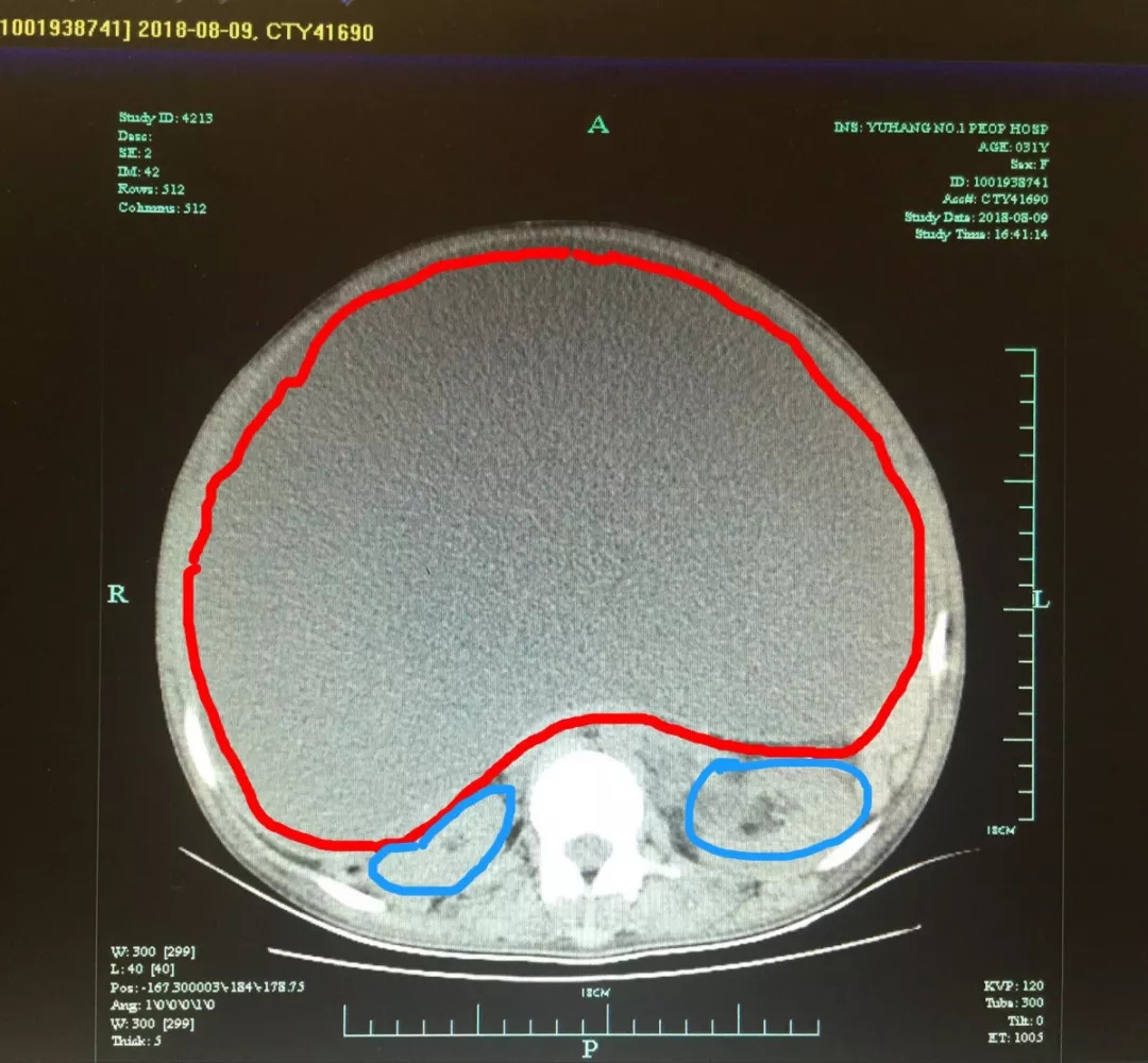 ct影像显示两侧肾脏(蓝色)受到肿瘤(红色)严重挤压
