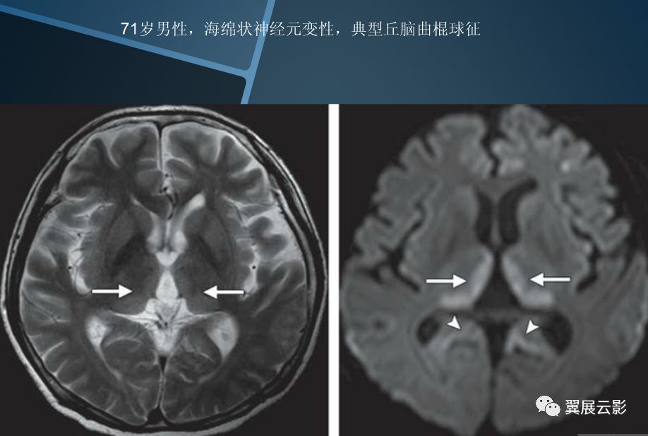 基底节区及丘脑对称性病变mri诊断