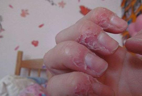 咬手指成瘾是强迫症,后果比你想的还严重!