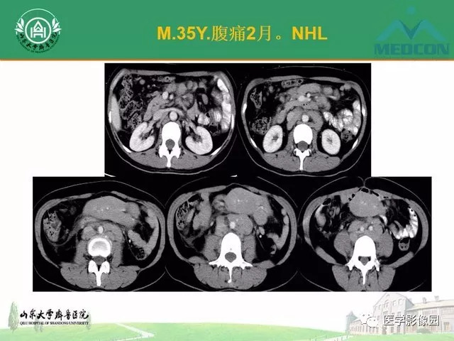 六种弥漫性腹膜病变ct诊断与鉴别诊断影像天地