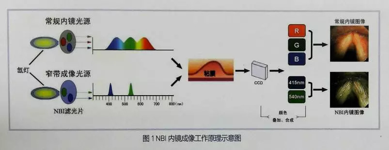 嗓子哑了1个月窄带成像技术nbi发现竟是声带癌