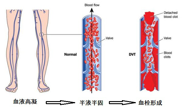 有血栓的人口比例_腿上有血栓真人图片(3)