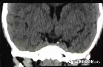 【基本知识】垂体的正常表现及垂体瘤的影像诊断