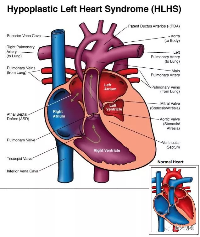心脏发育不全怎么办