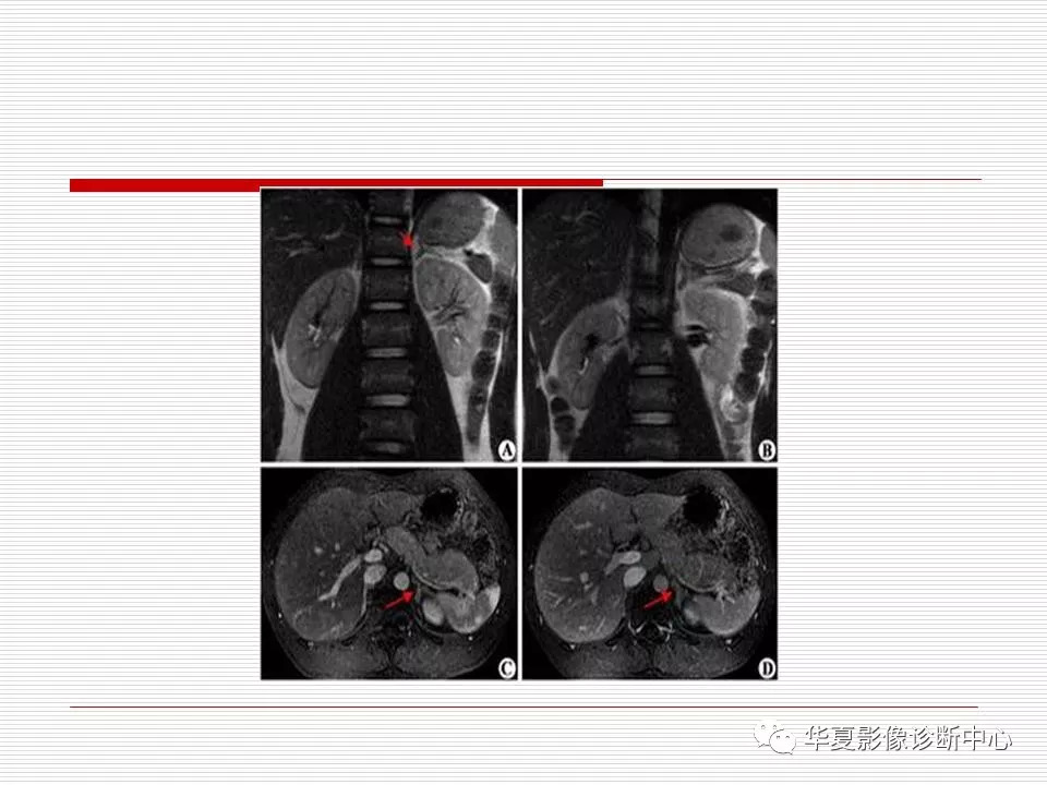 肾上腺解剖及常见病变诊断