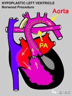 心脏发育不全怎么办