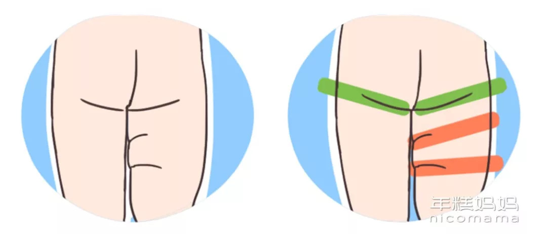 宝宝体检时"腿纹不对称"?医生说可能是这个有问题