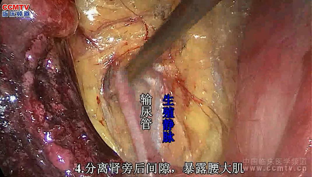 符伟军张旭解剖性后腹腔镜根治性左肾输尿管全长切除术