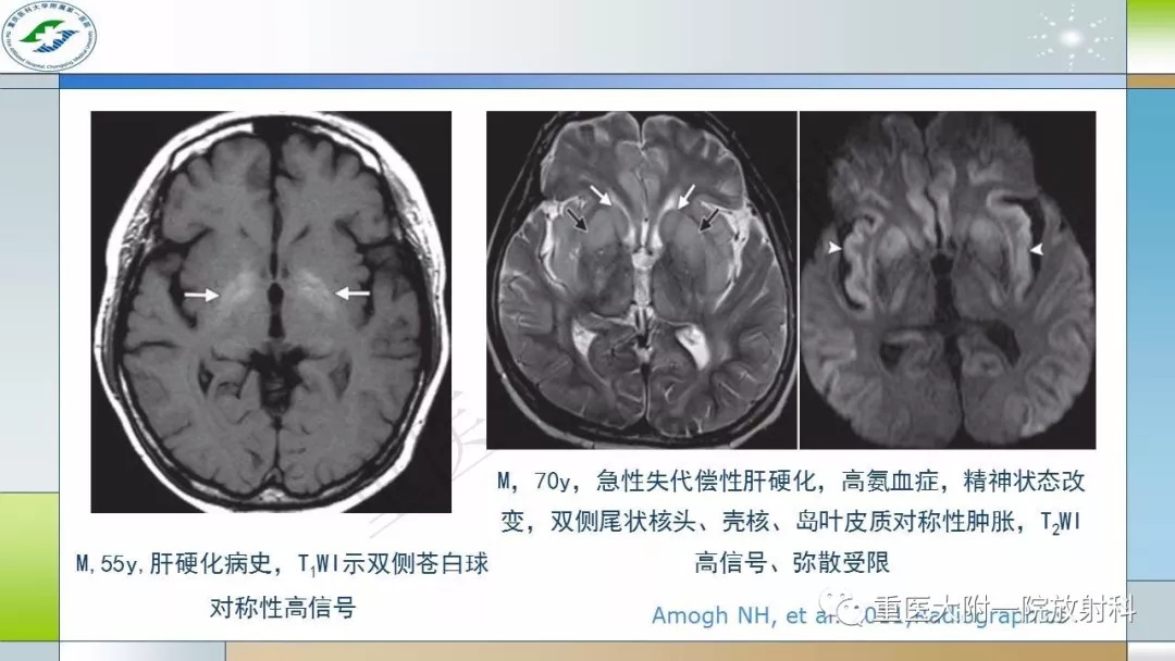 双侧基底节区对称性病变的鉴别诊断