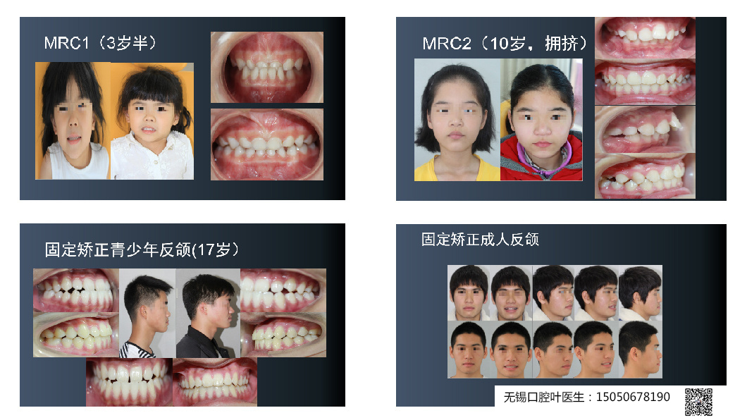 关于青少年矫正牙齿的问题,家长想了解的这里都有