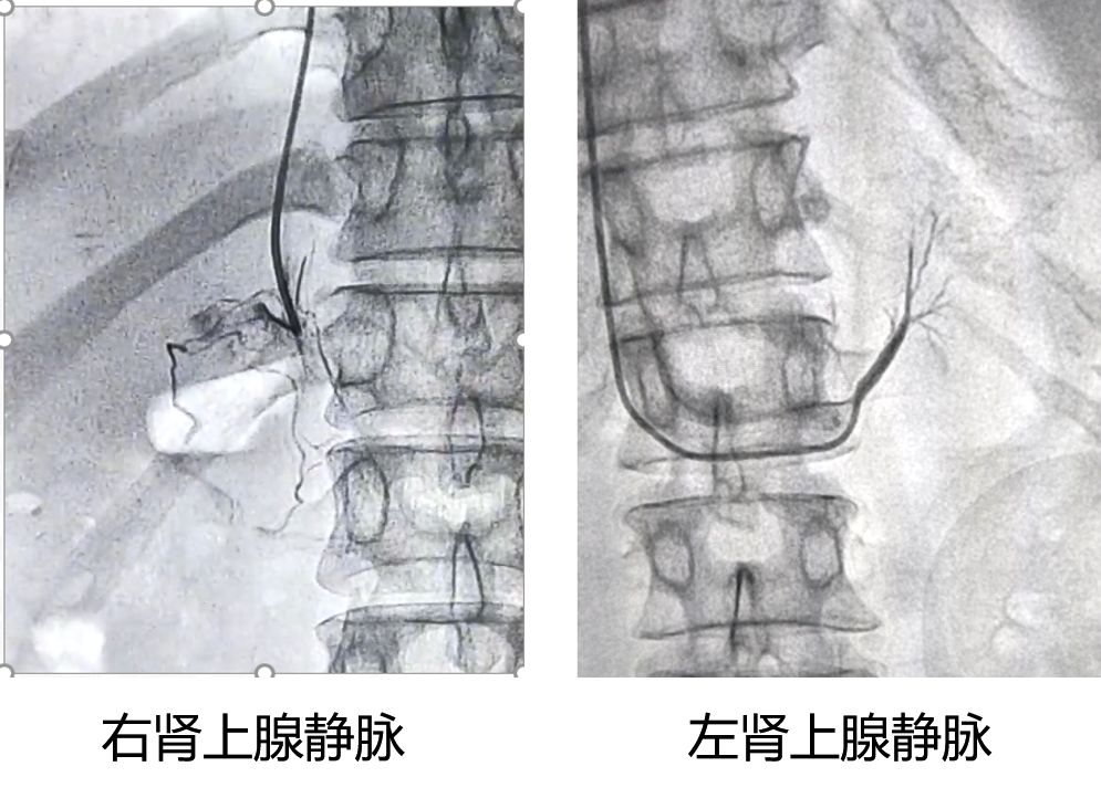 图2,全省率先开展分侧肾上腺静脉取血术,实现原发性醛固酮增多症的