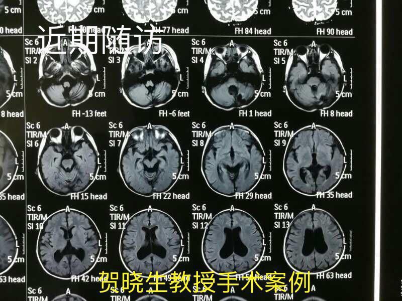 健康 正文  患儿女 7岁 步态不稳 来医院治疗;经检查为脑瘤;空军军医