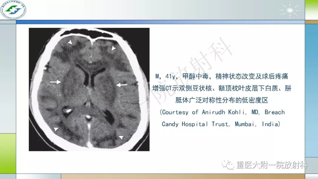 双侧基底节区对称性病变的鉴别诊断