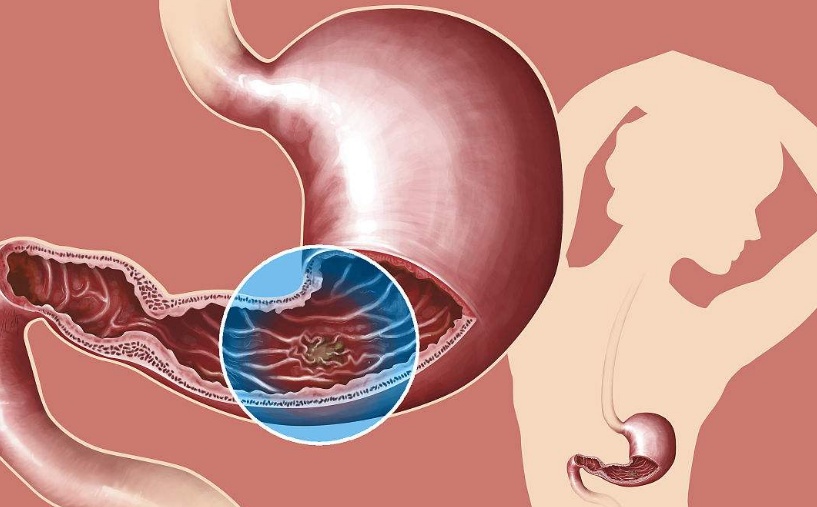 胃溃疡危害性有多大,胃糜烂和胃溃疡哪个更严重?