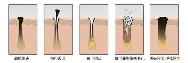 这时候如果强行把黑头拔出,毛孔反而会因为重新分泌的油脂而撑大,使