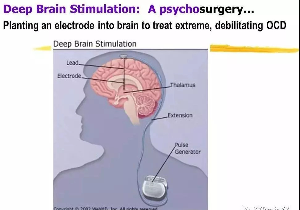 xbrain脑深部电刺激dbs的治疗现状