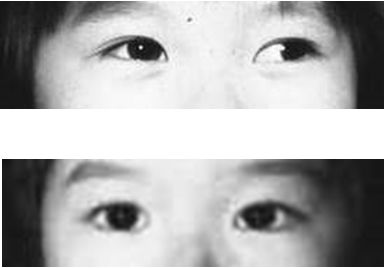 治疗失败 4  斜视手术  ▲外斜视儿童斜视矫正术前和术后的图片对比