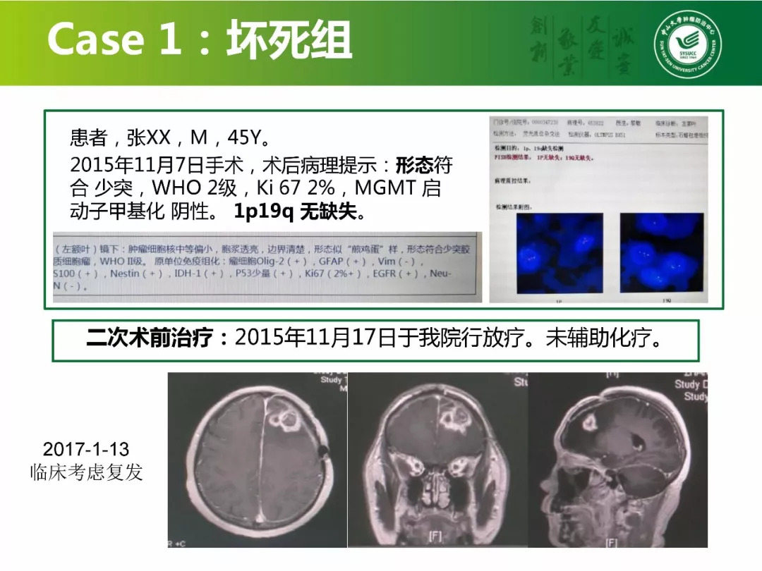 [cns2018]中山肿瘤陈忠平:复发胶质瘤再手术病理分析和后续治疗考虑