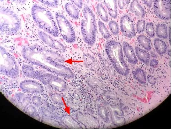 【医师笔记-叶子茵】(三十四)炎症性肠病的病理诊断是