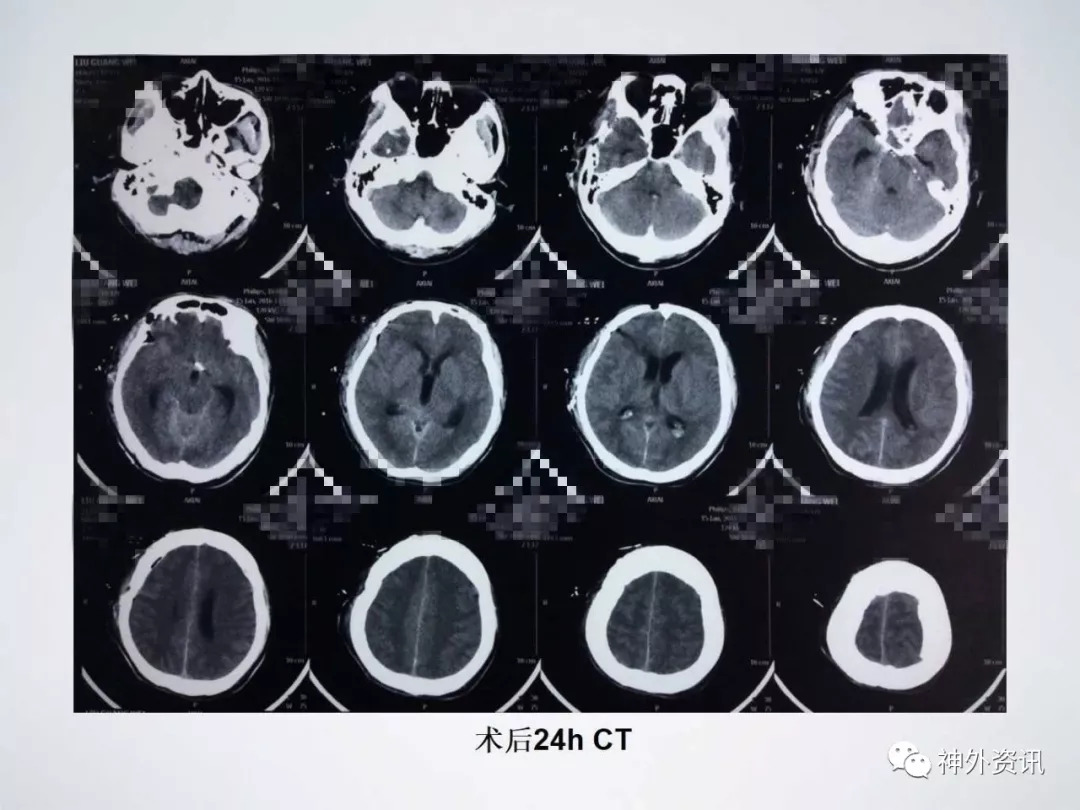 右侧后交通及左侧脉络膜前动脉动脉瘤经右侧翼点入路夹闭发病后9天ct