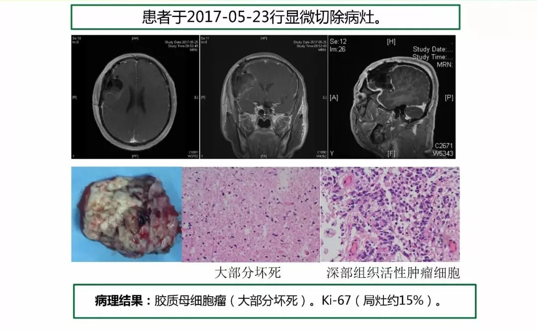 [cns2018]中山肿瘤陈忠平:复发胶质瘤再手术病理分析和后续治疗考虑