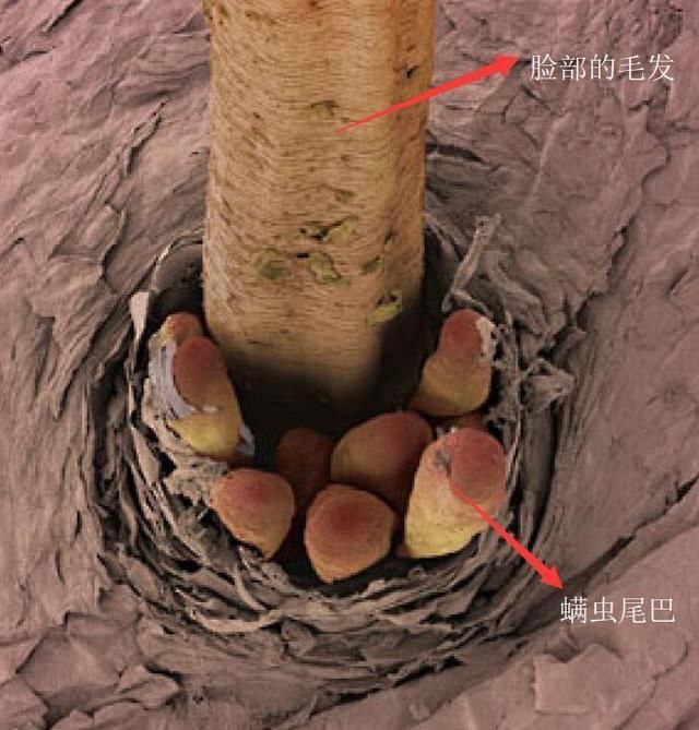 长在脸上的蠕形螨自然界的螨虫可是个大家族,多到数不过来.