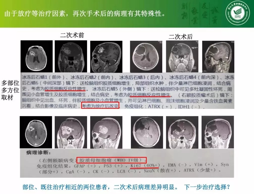 [cns2018]中山肿瘤陈忠平:复发胶质瘤再手术病理分析和后续治疗考虑