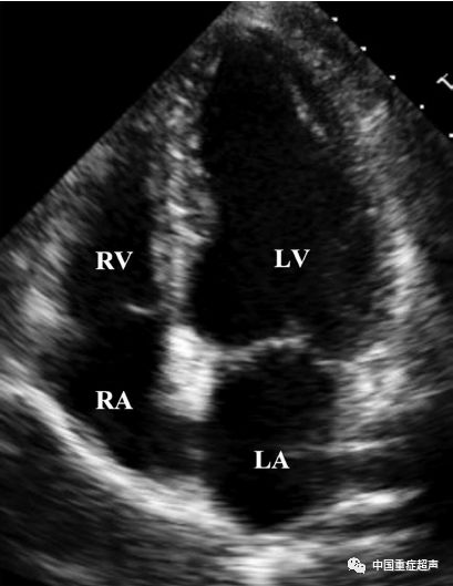 左心室(lv,左心房(la,右心房(ra,肺动脉(pa,肺动脉瓣(细箭头,三