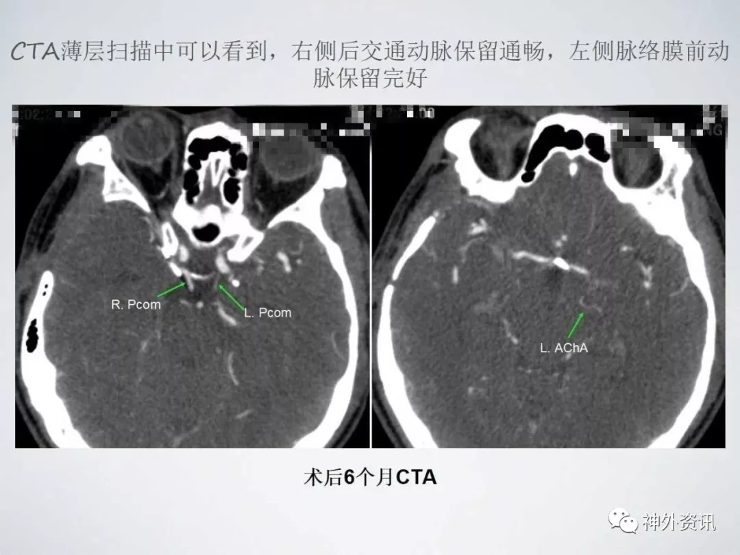 经右侧翼点入路夹闭右侧后交通及左侧脉络膜前动脉动脉瘤_治疗