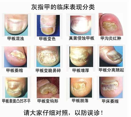 得灰指甲和美甲没关系?这些误区你要知道