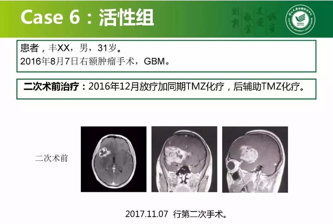 [cns2018]中山肿瘤陈忠平:复发胶质瘤再手术病理分析和后续治疗考虑