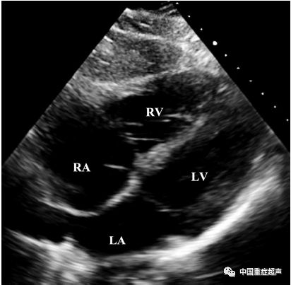 图4:常规经胸超声在心尖四腔心切面可见右心室(rv,左心室(lv,右心房