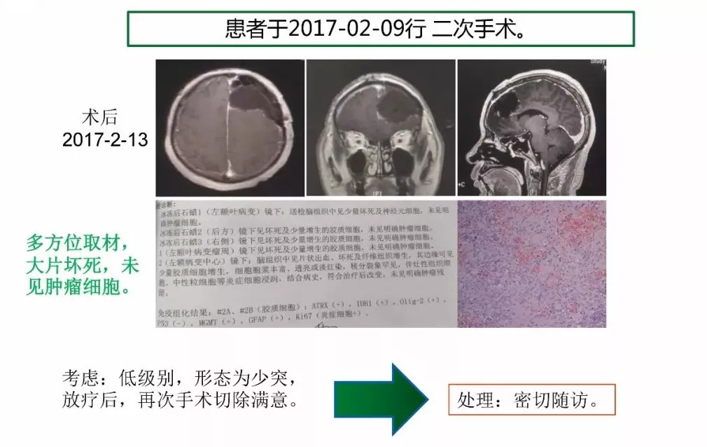 [cns2018]中山肿瘤陈忠平:复发胶质瘤再手术病理分析和后续治疗考虑