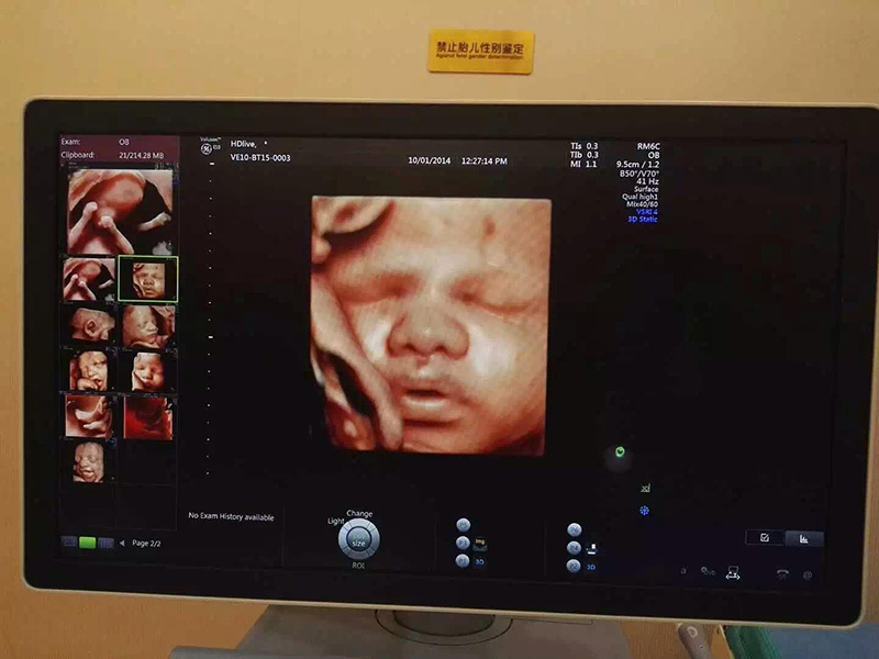 对于胎儿的检查也比较全面,通过三维或是四维彩超可以检查胎儿的小脑