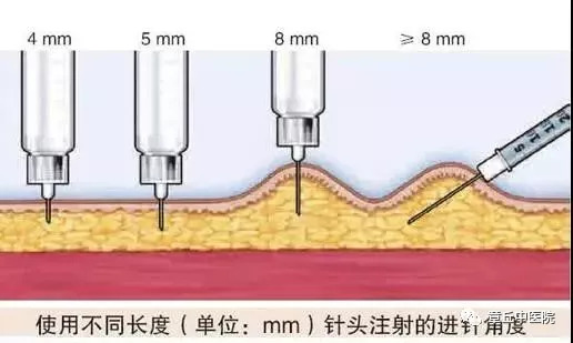 三,胰岛素的规范注射很重要