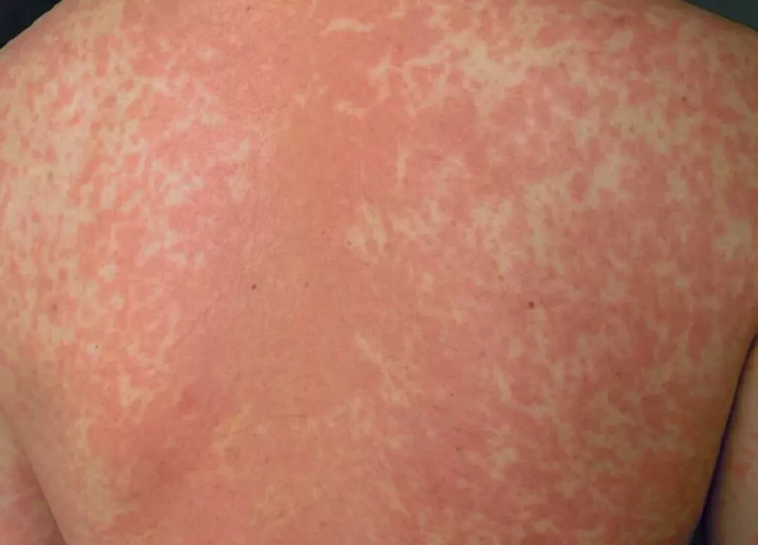 10 发疹型药疹 有些宝宝会对皮肤药物过敏,爆发发疹型药疹.