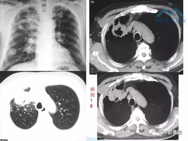 十种不典型肺结核少见病例影像及其分析影像天地