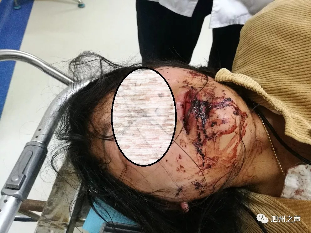 泗县大路口乡一妇女被丈夫多次家暴 嘴巴被缝了三四针