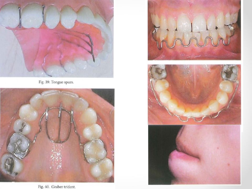 下图为舌刺,唇挡等辅助矫治器