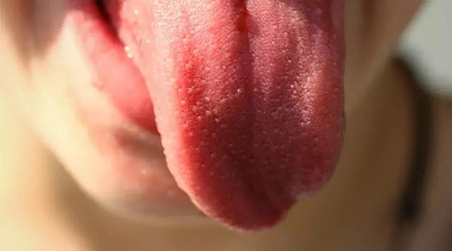 舌頭上出現斑點可能是嚴重疾病的徵兆 健康 第2張