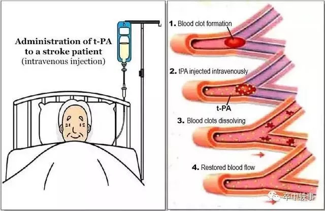 脑梗死请争分夺秒